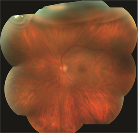 Retinal Detachment The American Society Of Retina