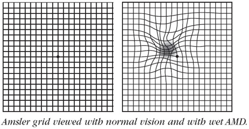 Age-Related Macular Degeneration - The American Society of Retina ...