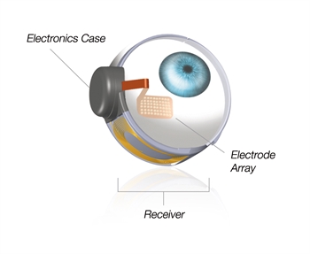 Bionic Eye Implant