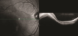 Choroidal Melanoma Retina Orange County