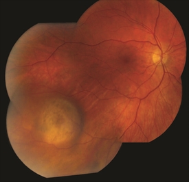 Choroidal Melanoma Retina Orange County