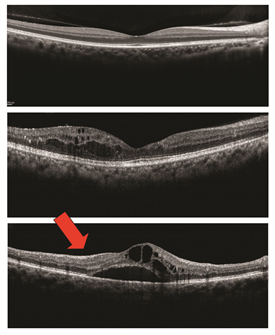 retinal edema causes)