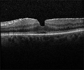 Macular Pucker @ Retina Orange County