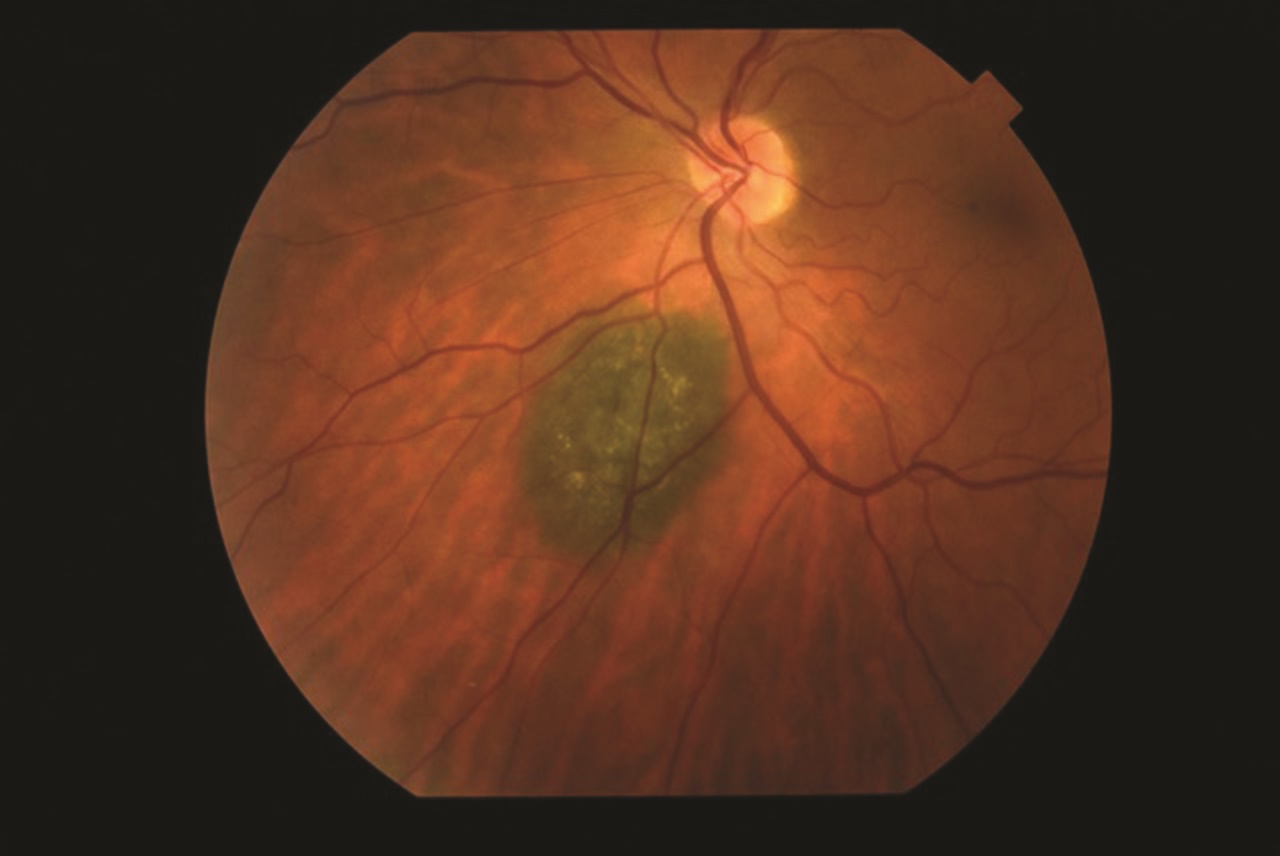 Choroidal Nevus With Lipofuscin