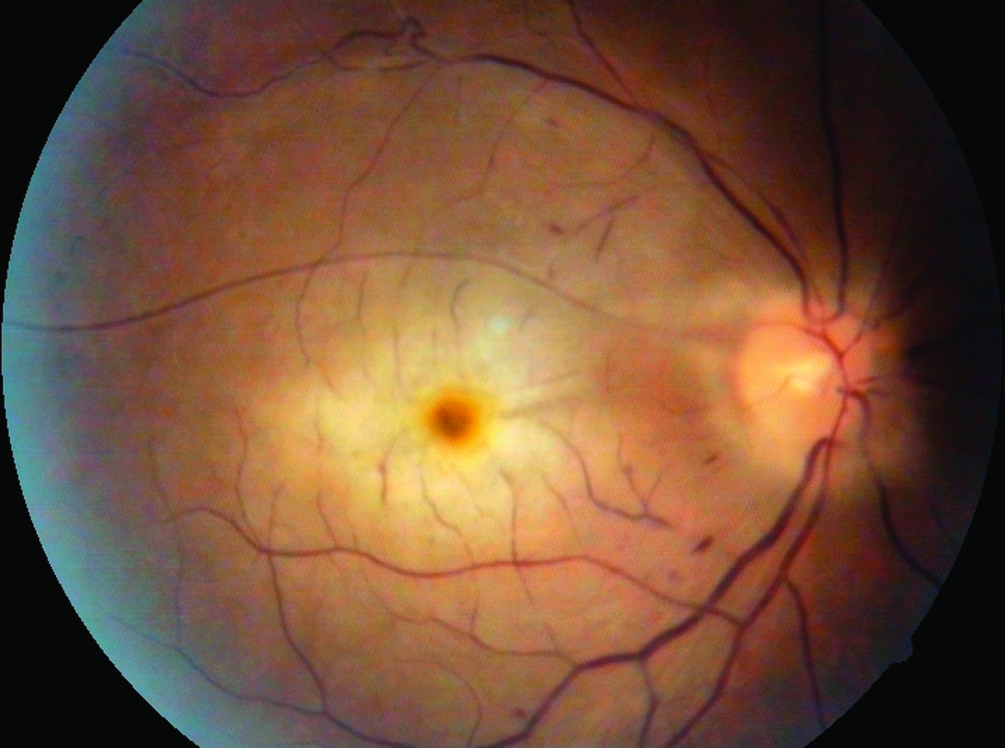 central retinal artery occlusion vs normal