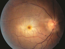 Retinal Artery Occlusion - The American Society of Retina Specialists Retinal Artery Occlusion - The American Society of Retina Specialists