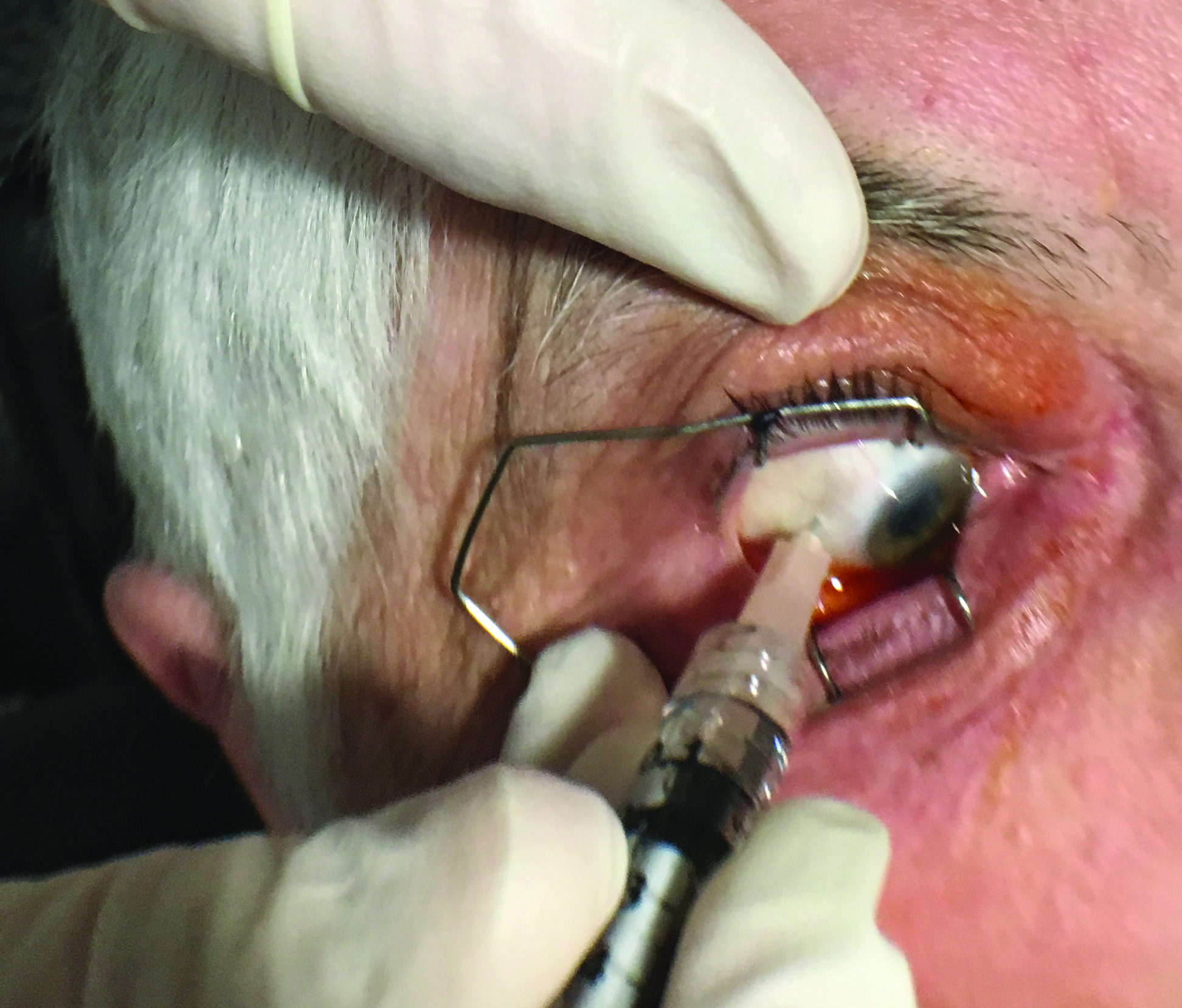 diabetic retinopathy treatment injection