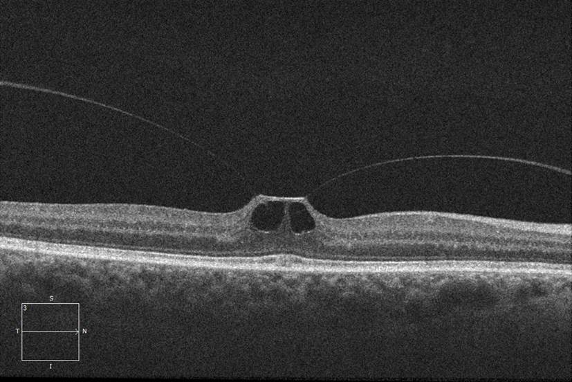 vmt retina vmt retina
