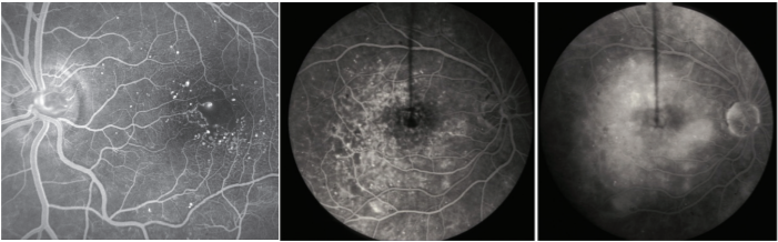 retina edema causes)