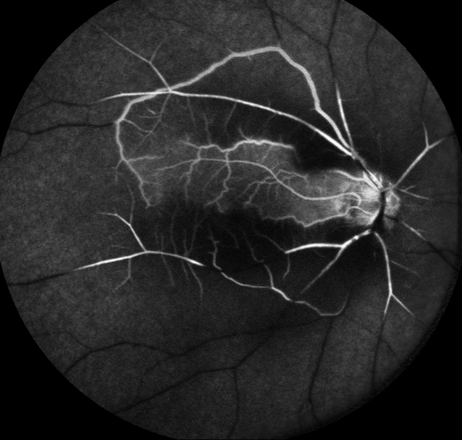 central retinal artery occlusion vs normal